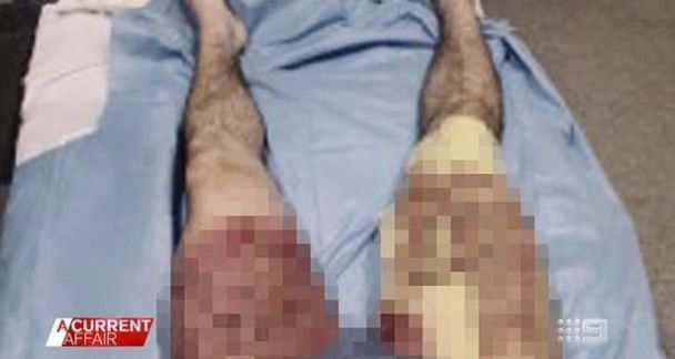 iPhone explotó en el bolsillo: hombre sufrió graves quemaduras (foto)