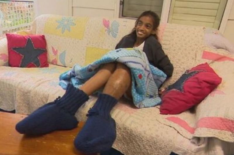Las piernas de una niña de 11 años son tan grandes que casi fueron amputadas: qué es esta enfermedad (foto)