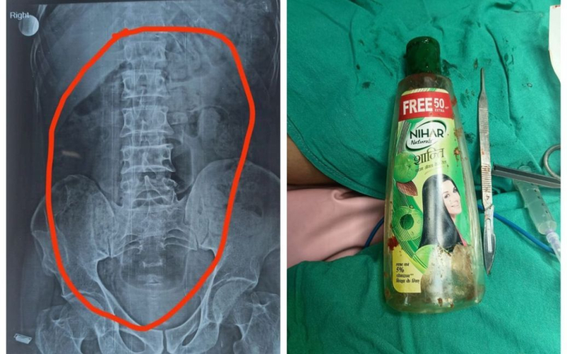 Médicos sacó una botella de 20 centímetros del estómago de un hombre foto