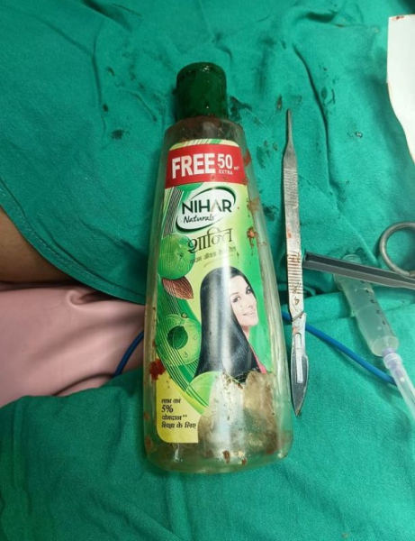 Los médicos se retiraron de estómago hombres una botella de 20cm – foto